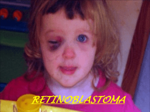retinoblastoma - WordPress.com